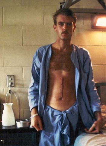 x Pre R & R emergency surgery, Steve had his appendix out